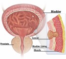 Bladder Disorders Plr Articles