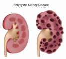 Kidney Disease Plr Articles