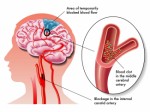 Stroke Plr Articles