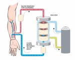 Hemodialysis Plr Articles