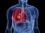 Lung Cancer Plr Articles