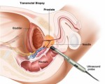 Prostate Cancer Plr Articles V2