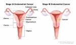 Uterine Cancer Plr Articles