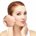 Acne Plr Articles V21