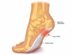 Plantar Fasciitis Plr Articles