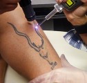 Tattoo Removal Plr Articles