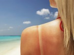 Sunburn Plr Articles