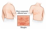 Shingles Plr Articles