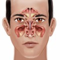 Sinus Infections Plr Articles V3