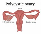 Polycystic Ovarian Syndrome Plr Articles