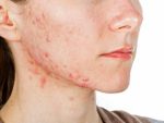 Acne PLR Articles v22