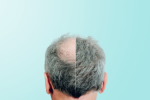 Hair Loss Plr Articles v12