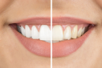 Teeth Whitening PLR Autoresponder Email Series