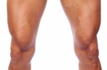 Varicose Veins Plr Articles
