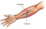 Broken Bones Plr Articles