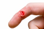 Herpes Plr Articles